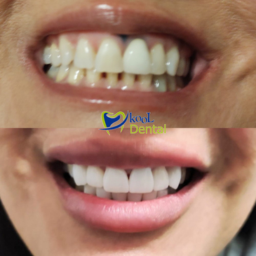 Slider image (9) Kool Dental